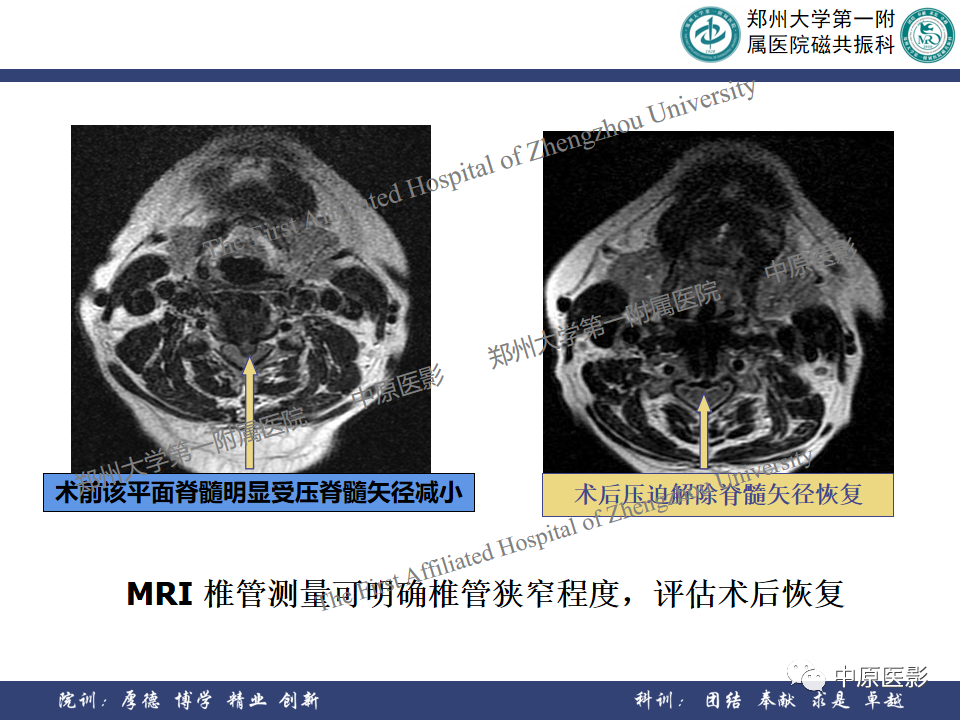 影像PPT - 【PPT】磁共振在颈椎病中的应用-37