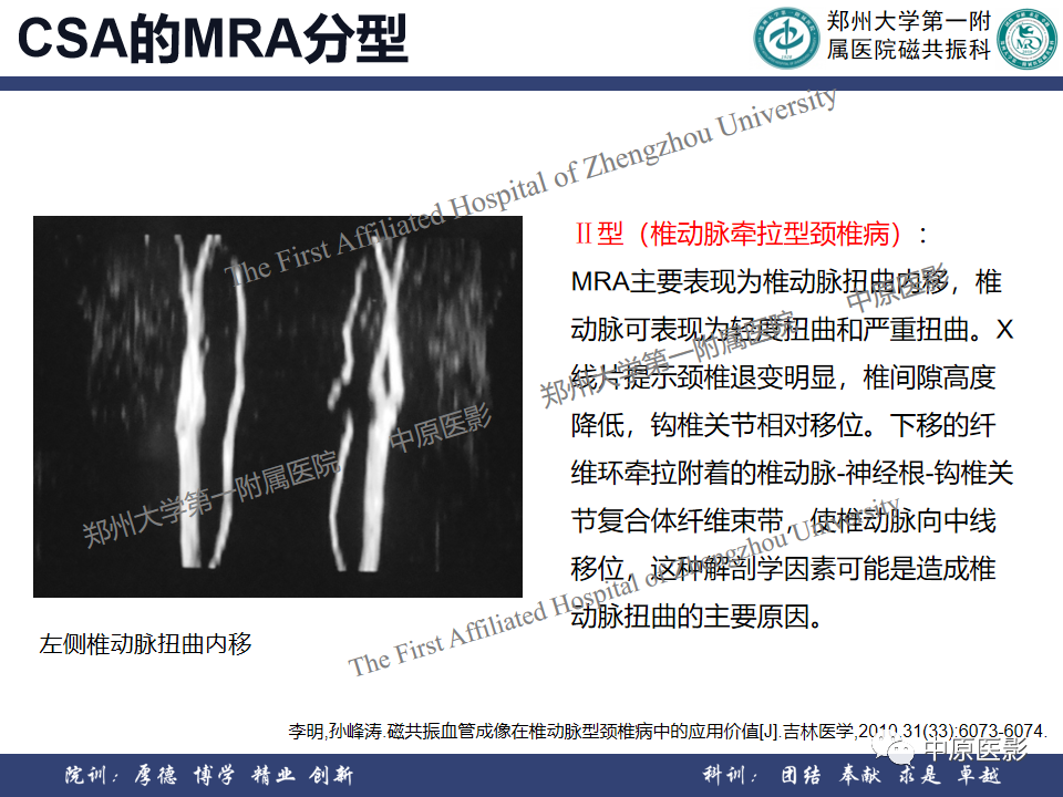 影像PPT - 【PPT】磁共振在颈椎病中的应用-42