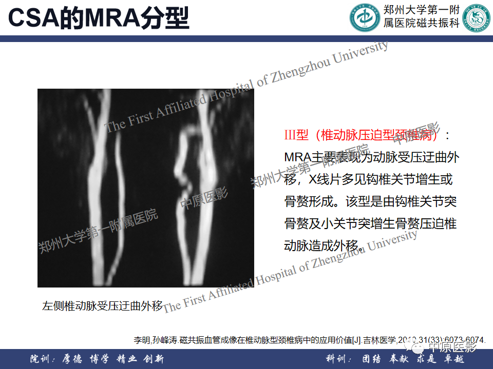 影像PPT - 【PPT】磁共振在颈椎病中的应用-43