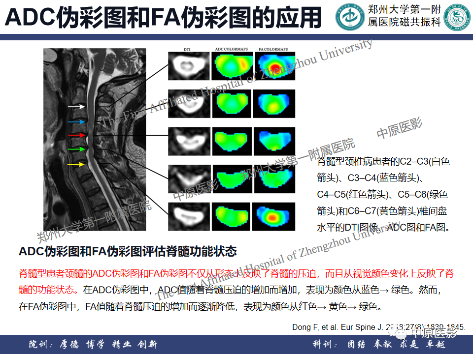 影像PPT - 【PPT】磁共振在颈椎病中的应用-53