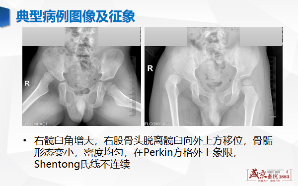 影像PPT - 【PPT】发育性髋关节发育不良-4