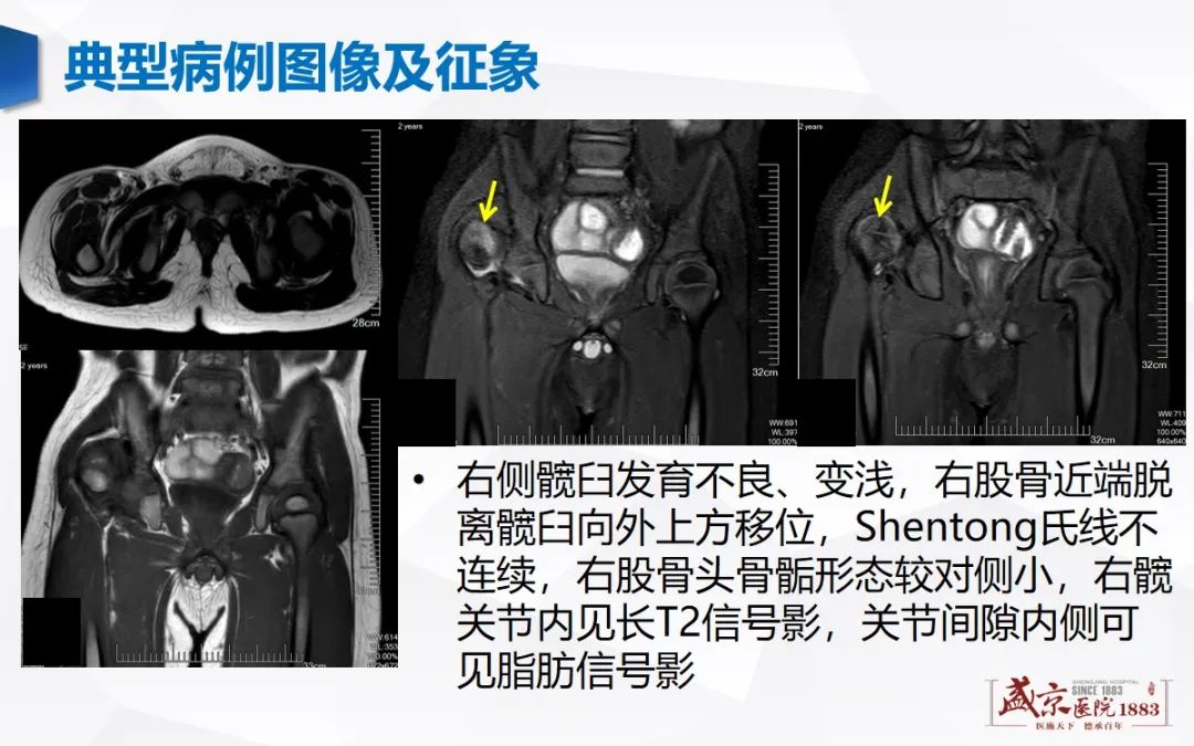 影像PPT - 【PPT】发育性髋关节发育不良-5