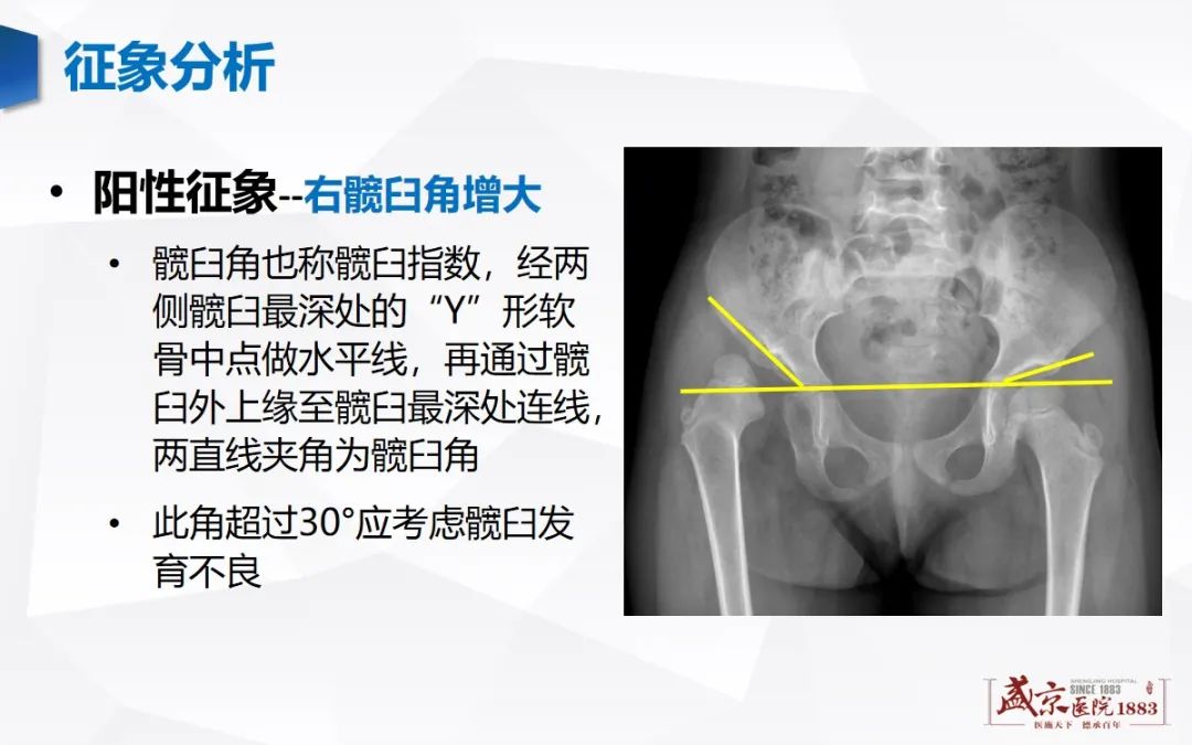 影像PPT - 【PPT】发育性髋关节发育不良-6