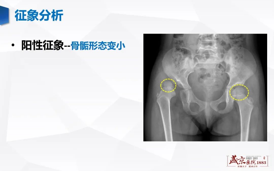 影像PPT - 【PPT】发育性髋关节发育不良-7