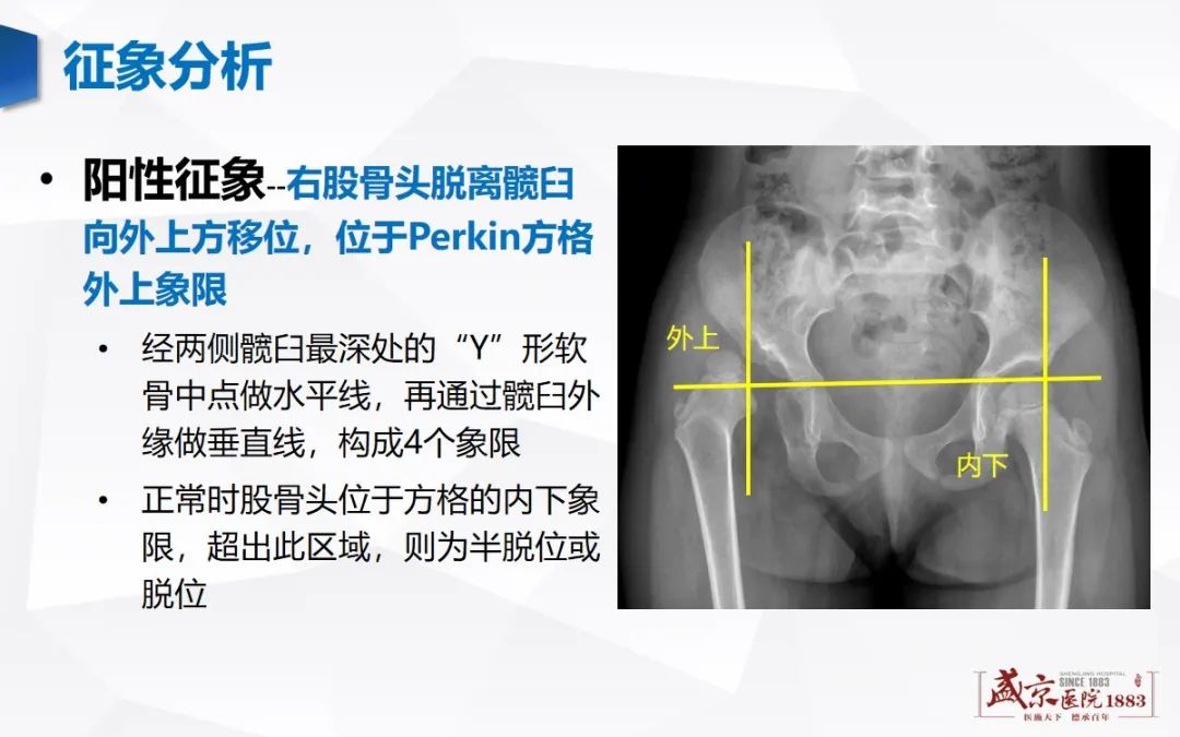 影像PPT - 【PPT】发育性髋关节发育不良-8