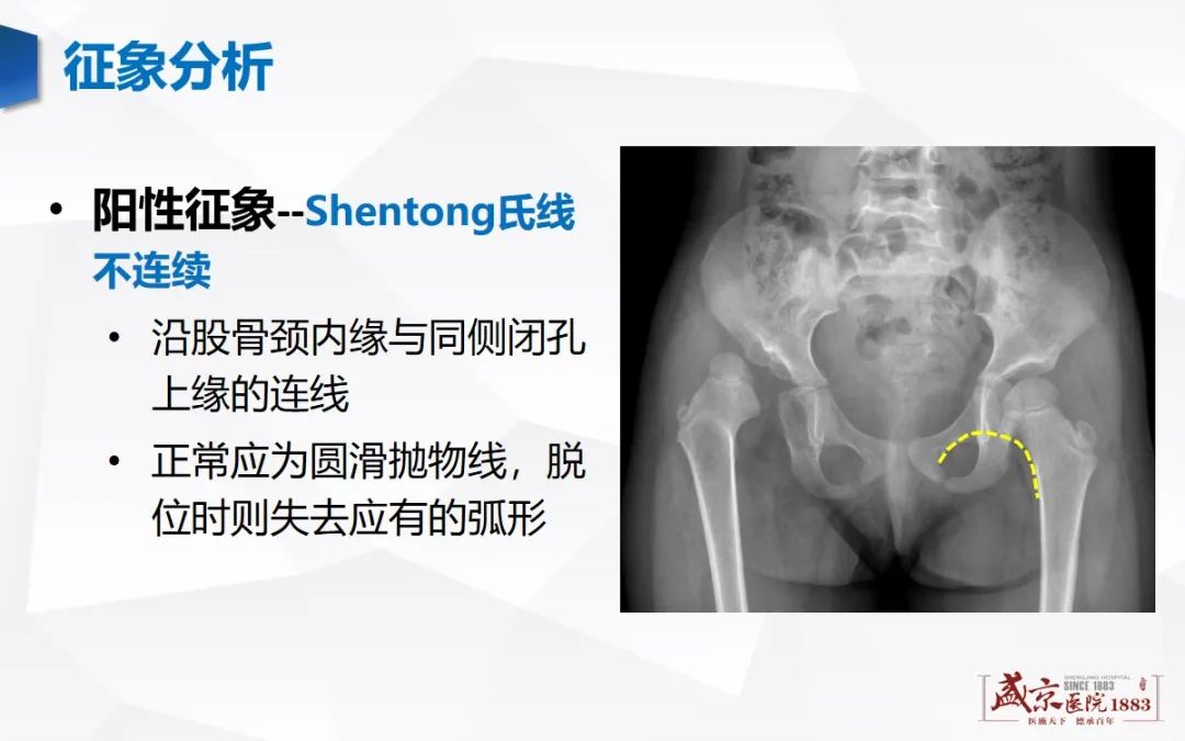 影像PPT - 【PPT】发育性髋关节发育不良-9
