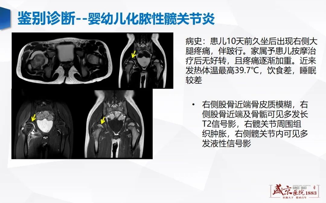影像PPT - 【PPT】发育性髋关节发育不良-11