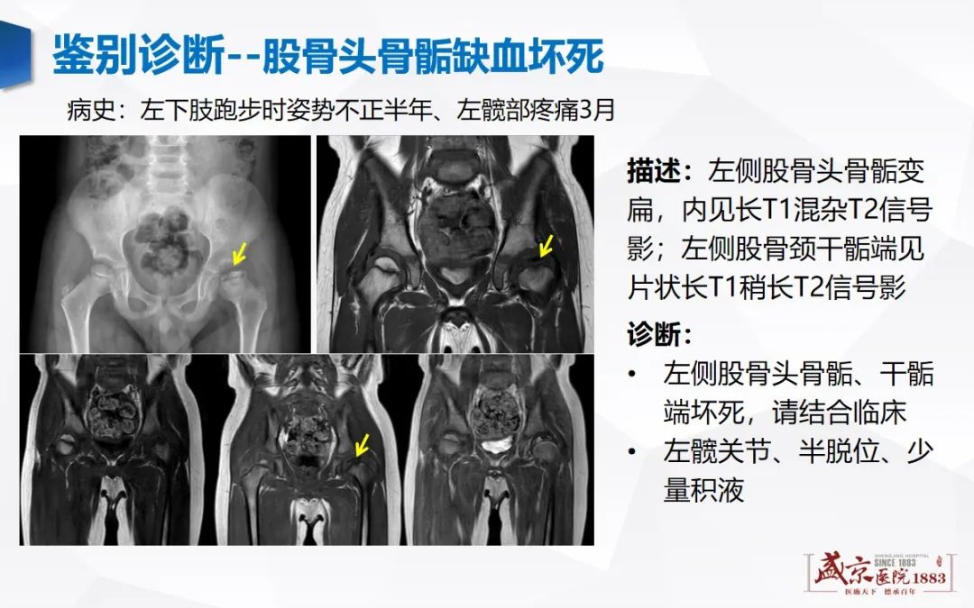 影像PPT - 【PPT】发育性髋关节发育不良-13