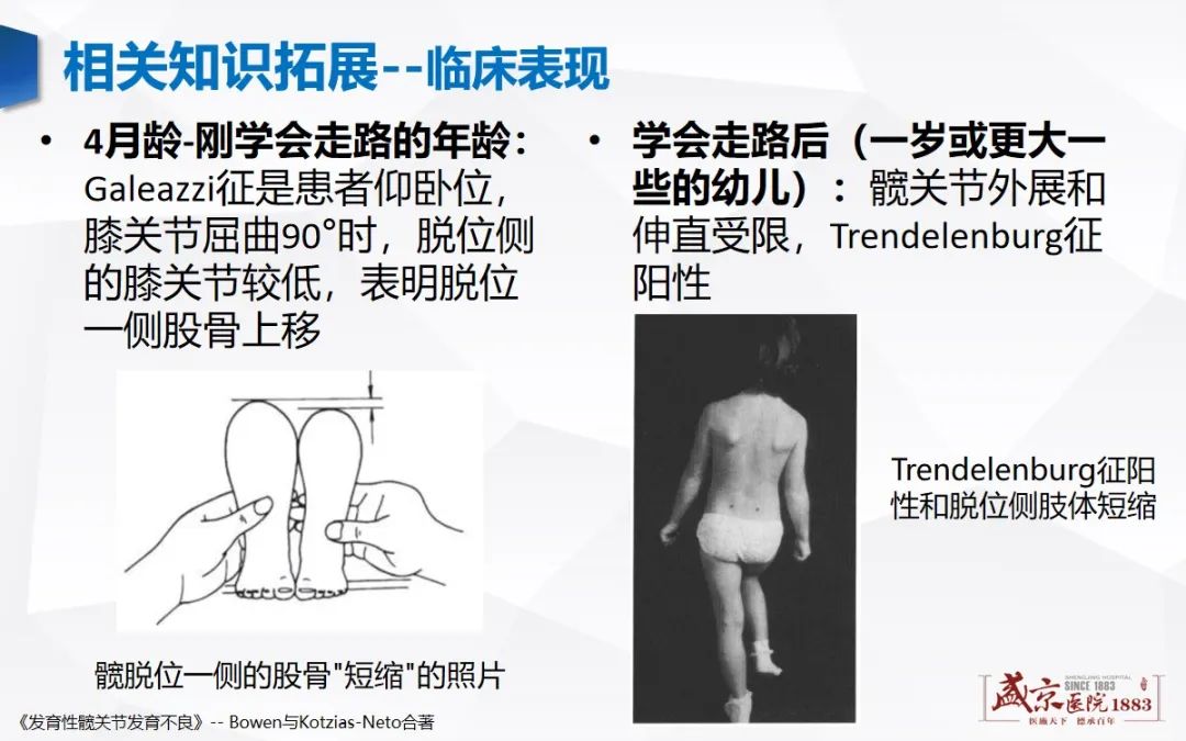 影像PPT - 【PPT】发育性髋关节发育不良-18