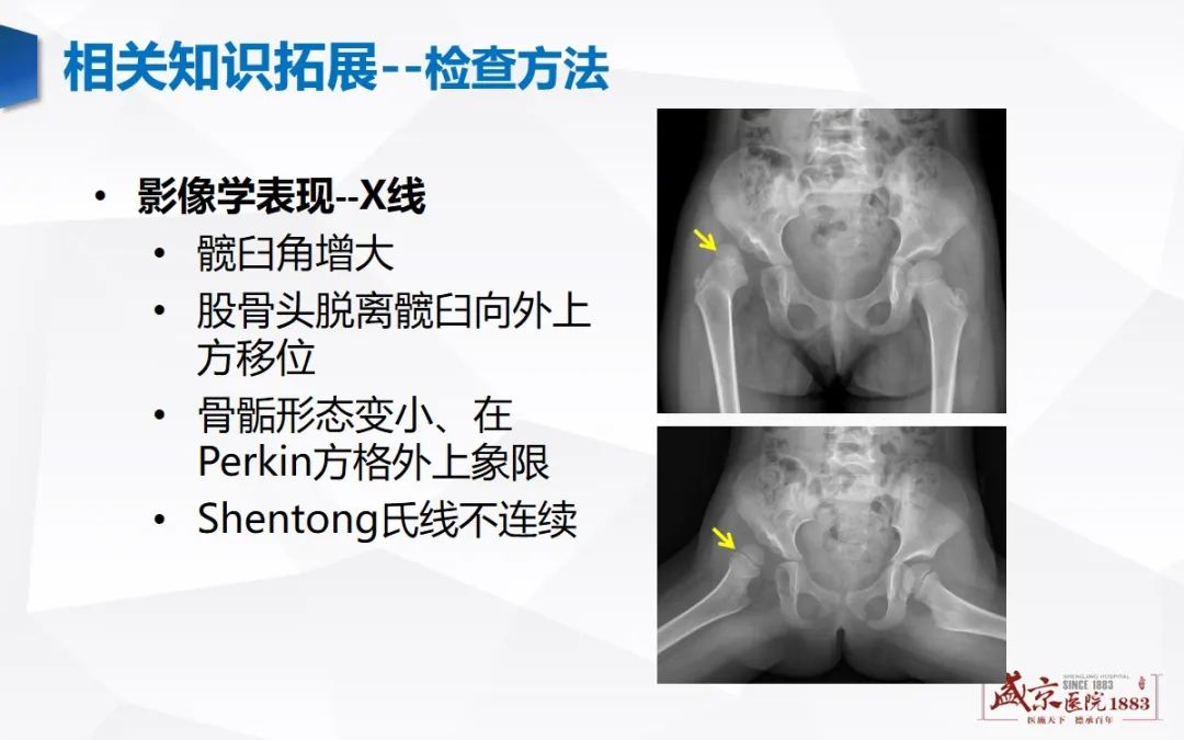 影像PPT - 【PPT】发育性髋关节发育不良-20