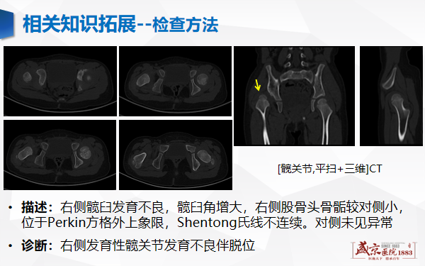 影像PPT - 【PPT】发育性髋关节发育不良-22