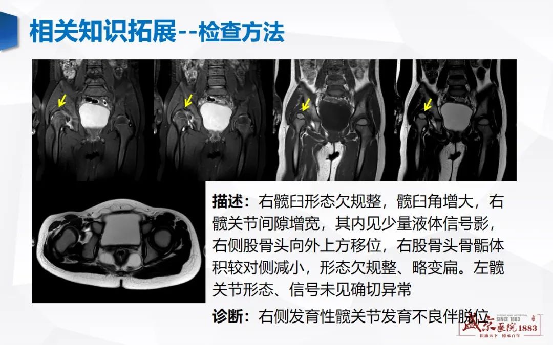 影像PPT - 【PPT】发育性髋关节发育不良-24