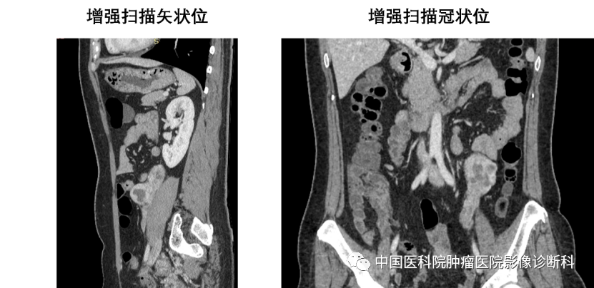 影像PPT - 【病例】腹膜后平滑肌肉瘤1例CT及MR影像-3 影像PPT - 【病例】腹膜后平滑肌肉瘤1例CT及MR影像-3