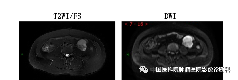 影像PPT - 【病例】腹膜后平滑肌肉瘤1例CT及MR影像-5 影像PPT - 【病例】腹膜后平滑肌肉瘤1例CT及MR影像-5