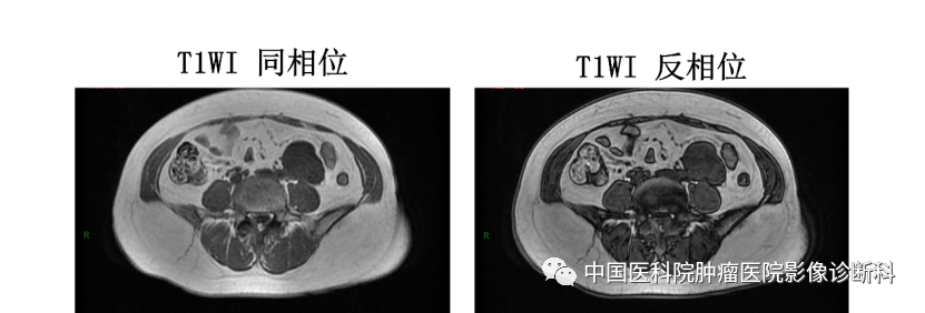 影像PPT - 【病例】腹膜后平滑肌肉瘤1例CT及MR影像-4 影像PPT - 【病例】腹膜后平滑肌肉瘤1例CT及MR影像-4