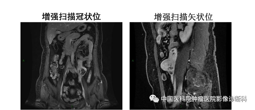 影像PPT - 【病例】腹膜后平滑肌肉瘤1例CT及MR影像-8 影像PPT - 【病例】腹膜后平滑肌肉瘤1例CT及MR影像-8