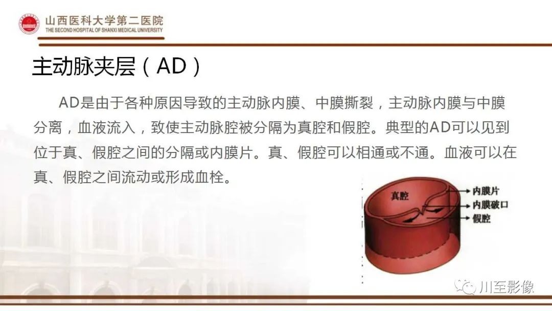 影像PPT - 【PPT】马方综合征-10