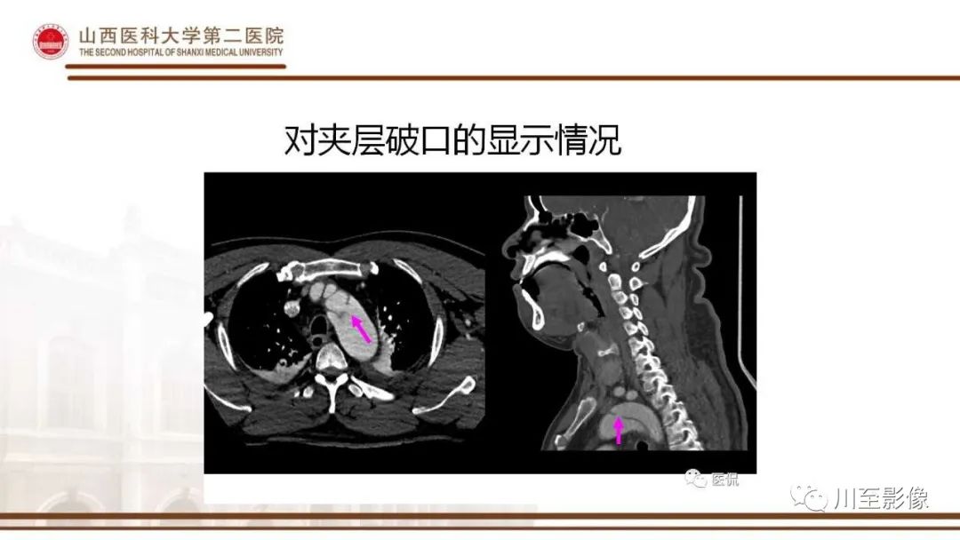 影像PPT - 【PPT】马方综合征-15