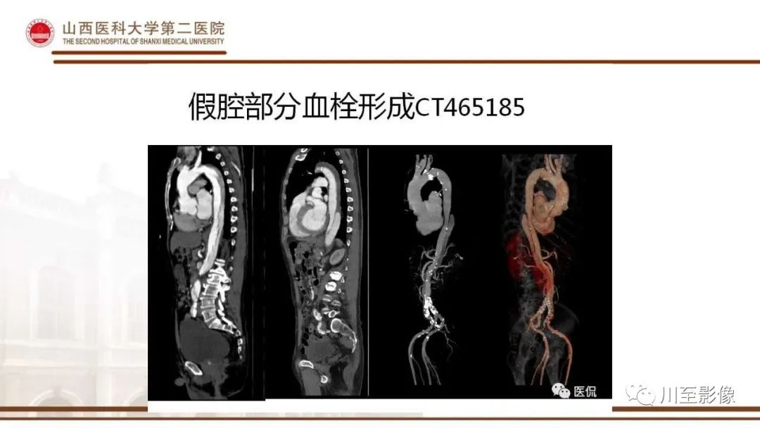 影像PPT - 【PPT】马方综合征-17