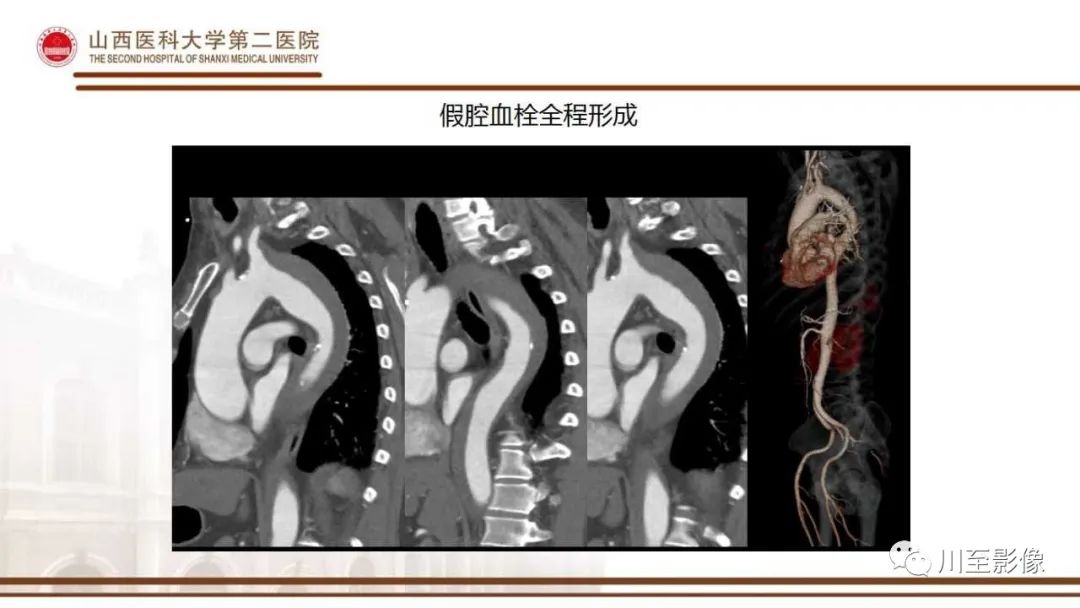 影像PPT - 【PPT】马方综合征-16