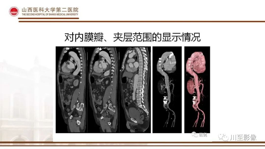 影像PPT - 【PPT】马方综合征-18