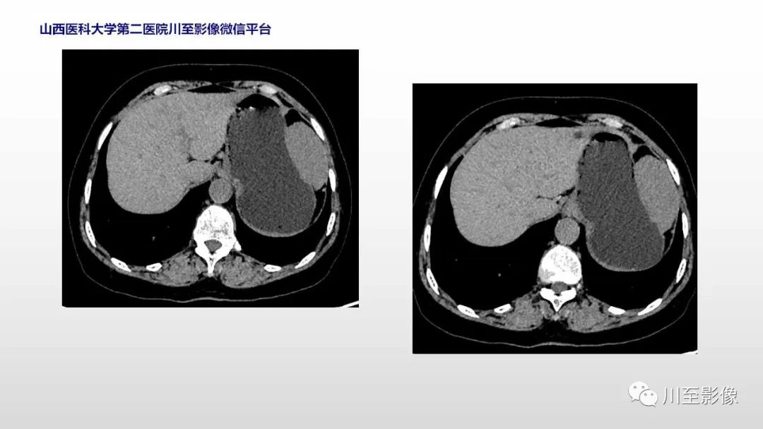 影像PPT - 【PPT】胃肠道间质瘤-3