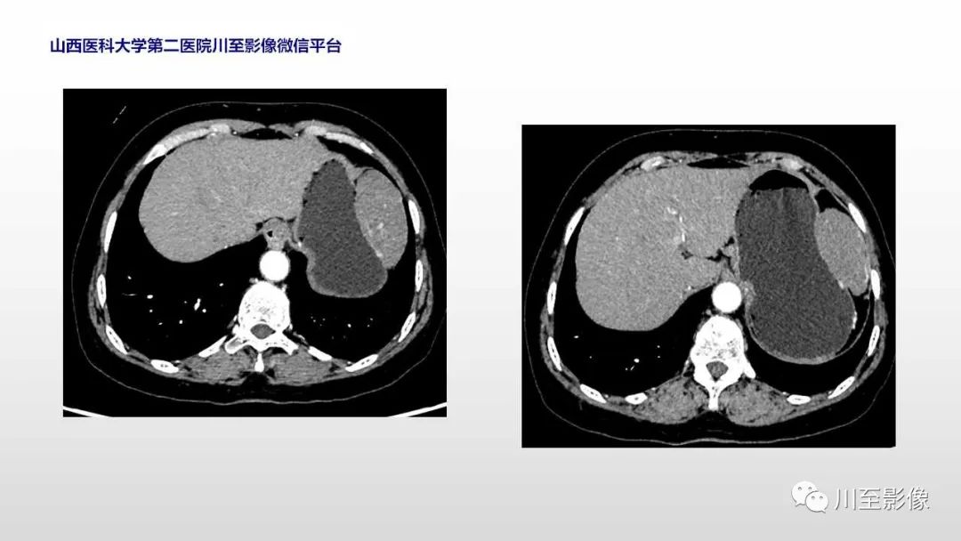 影像PPT - 【PPT】胃肠道间质瘤-4