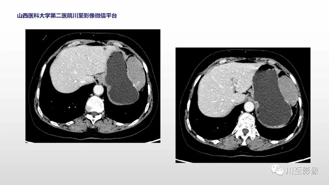 影像PPT - 【PPT】胃肠道间质瘤-5