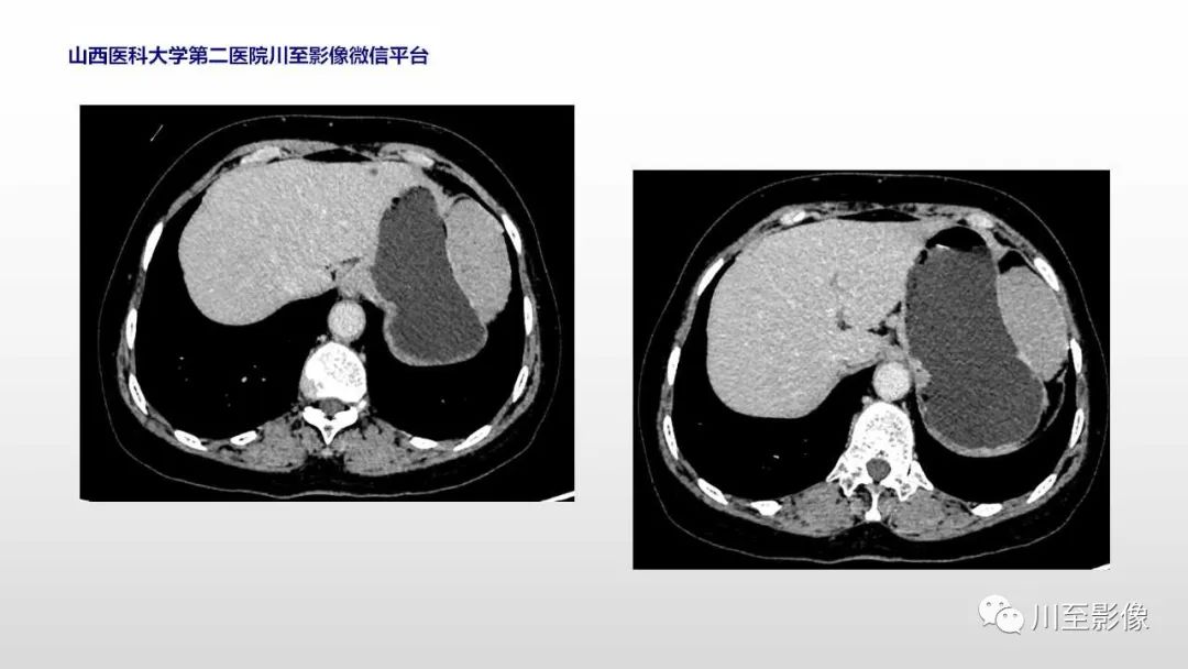 影像PPT - 【PPT】胃肠道间质瘤-6