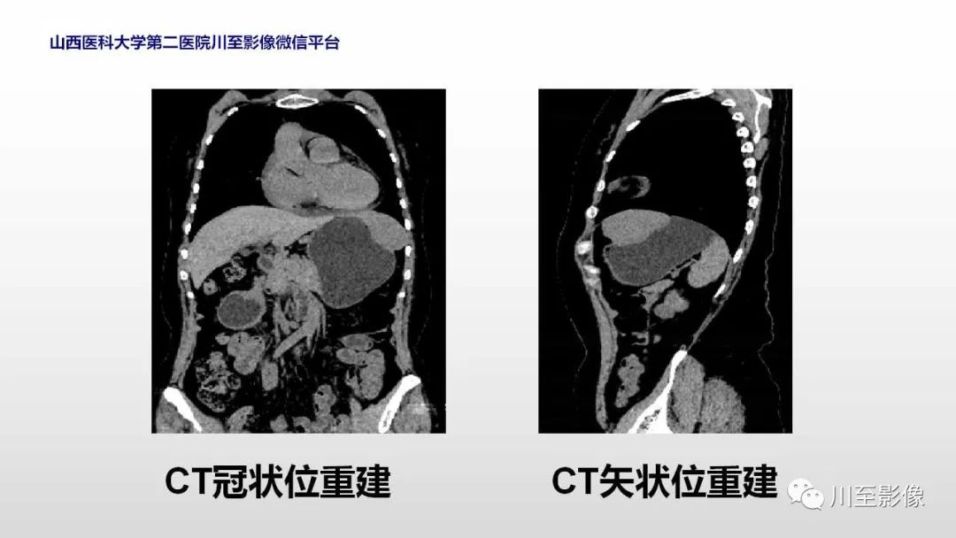 影像PPT - 【PPT】胃肠道间质瘤-7