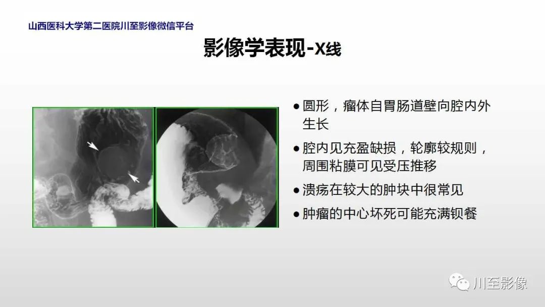 影像PPT - 【PPT】胃肠道间质瘤-18