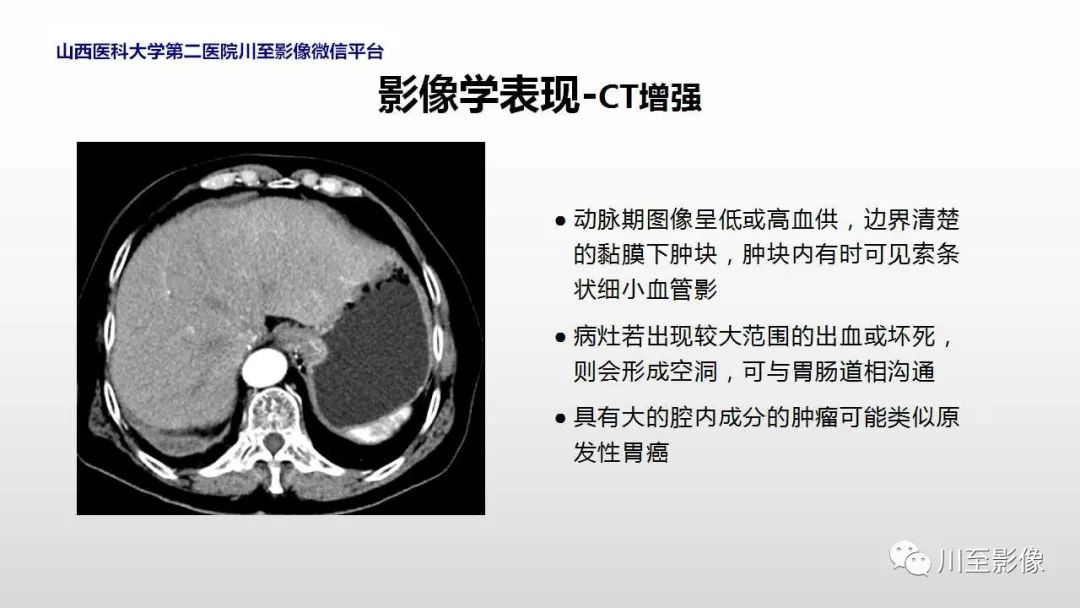 影像PPT - 【PPT】胃肠道间质瘤-20