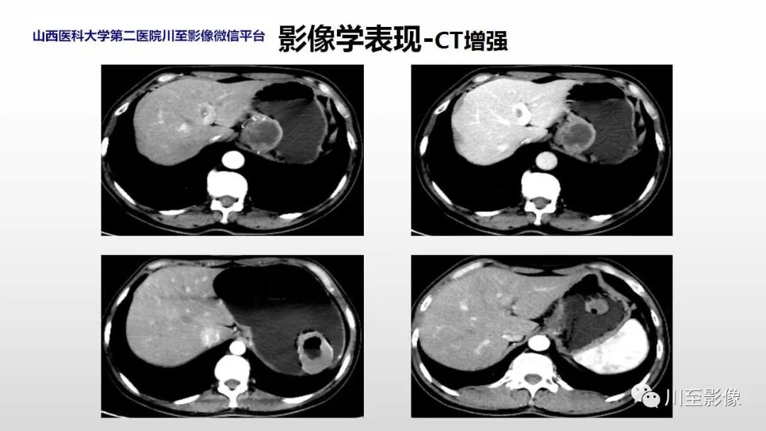 影像PPT - 【PPT】胃肠道间质瘤-21