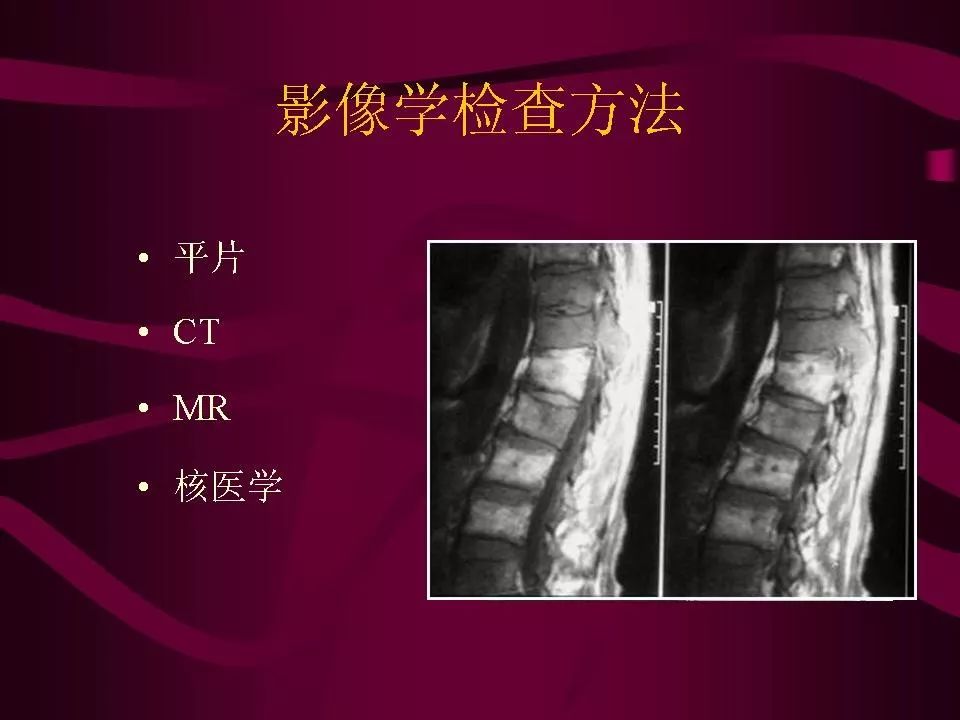 影像PPT - 【PPT】骨转移瘤的影像诊断-12