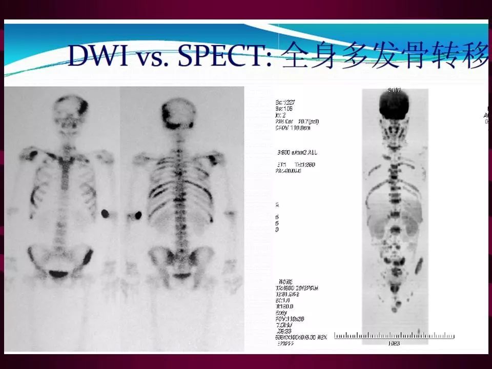 影像PPT - 【PPT】骨转移瘤的影像诊断-13