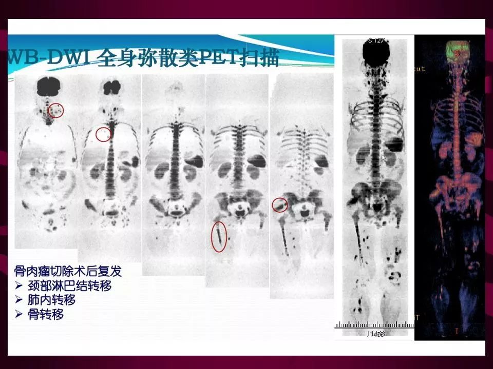 影像PPT - 【PPT】骨转移瘤的影像诊断-14