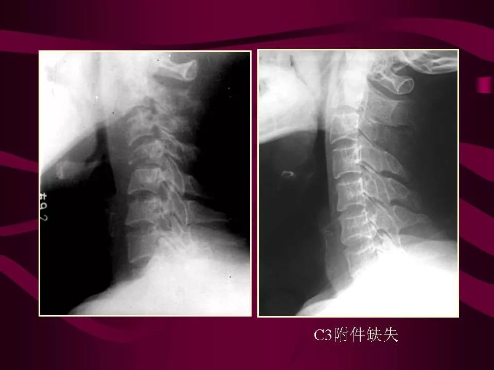 影像PPT - 【PPT】骨转移瘤的影像诊断-17