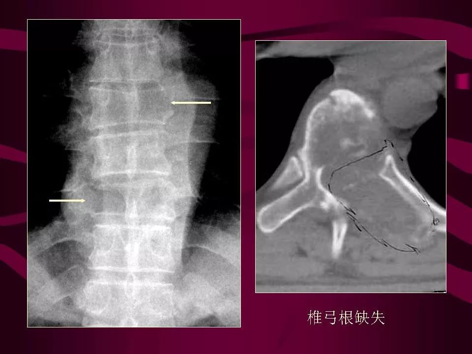 影像PPT - 【PPT】骨转移瘤的影像诊断-18