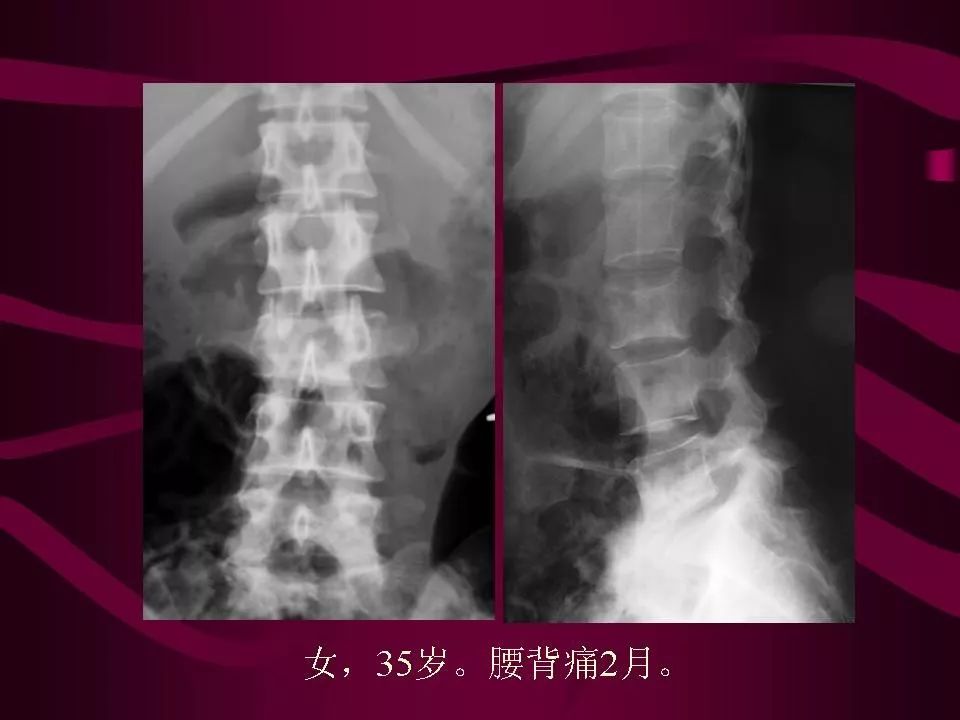 影像PPT - 【PPT】骨转移瘤的影像诊断-19