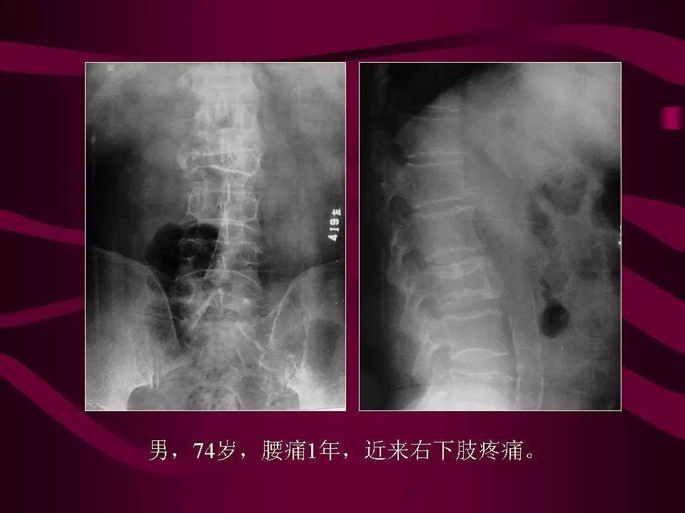 影像PPT - 【PPT】骨转移瘤的影像诊断-21