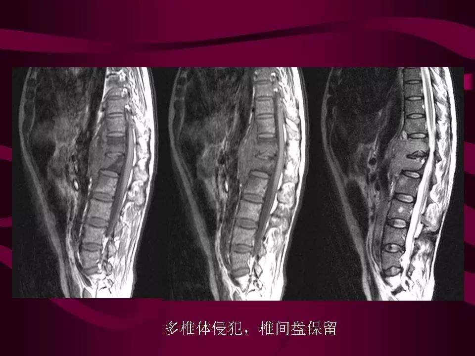 影像PPT - 【PPT】骨转移瘤的影像诊断-23
