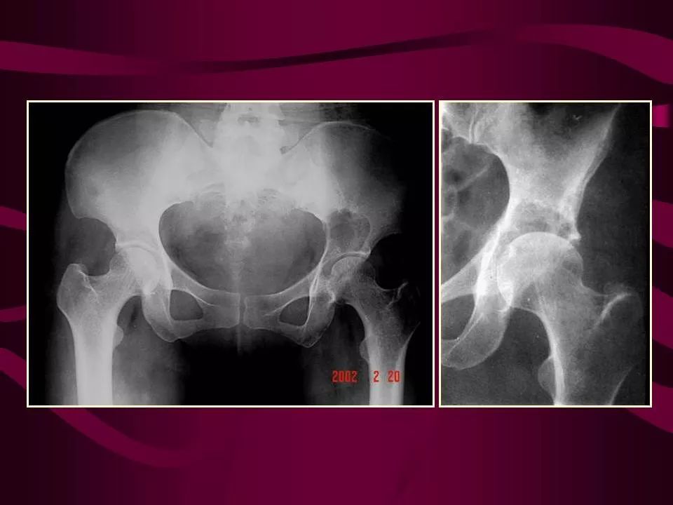 影像PPT - 【PPT】骨转移瘤的影像诊断-24