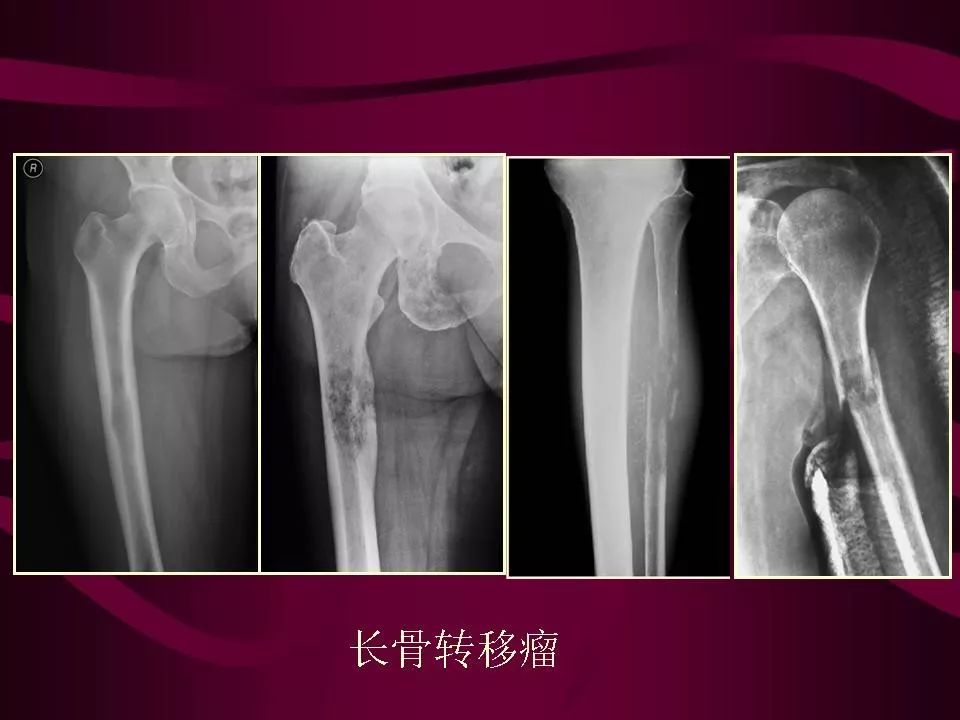 影像PPT - 【PPT】骨转移瘤的影像诊断-28