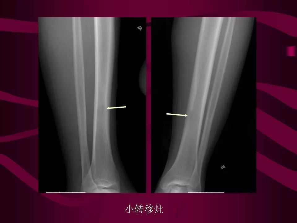 影像PPT - 【PPT】骨转移瘤的影像诊断-29