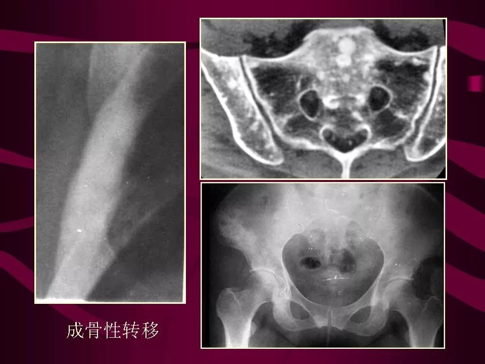 影像PPT - 【PPT】骨转移瘤的影像诊断-31