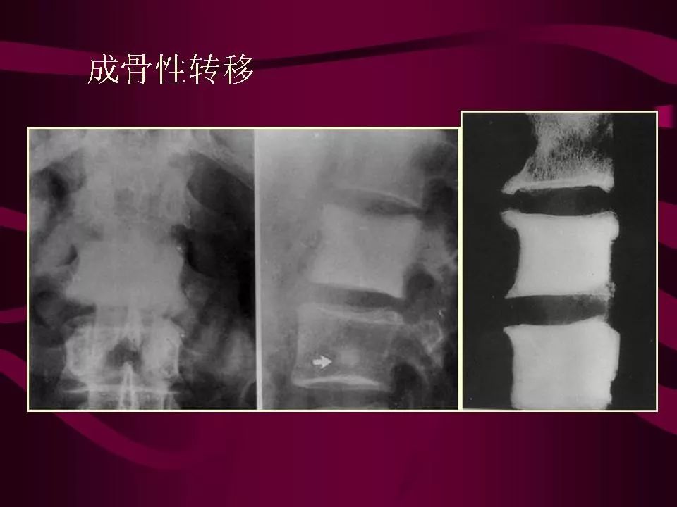 影像PPT - 【PPT】骨转移瘤的影像诊断-32