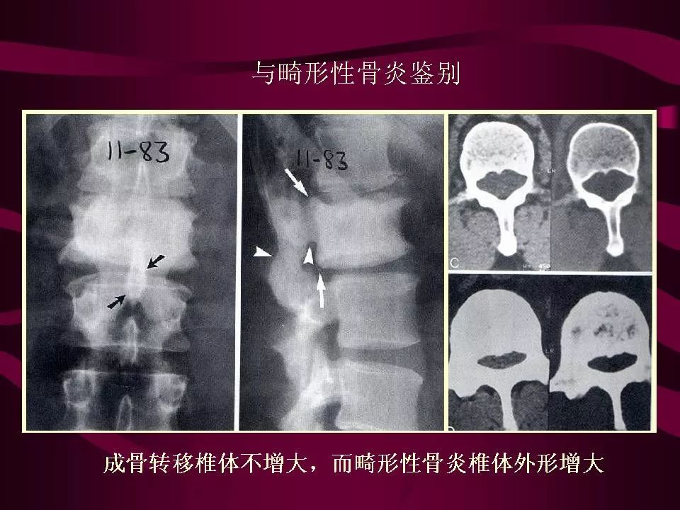 影像PPT - 【PPT】骨转移瘤的影像诊断-33