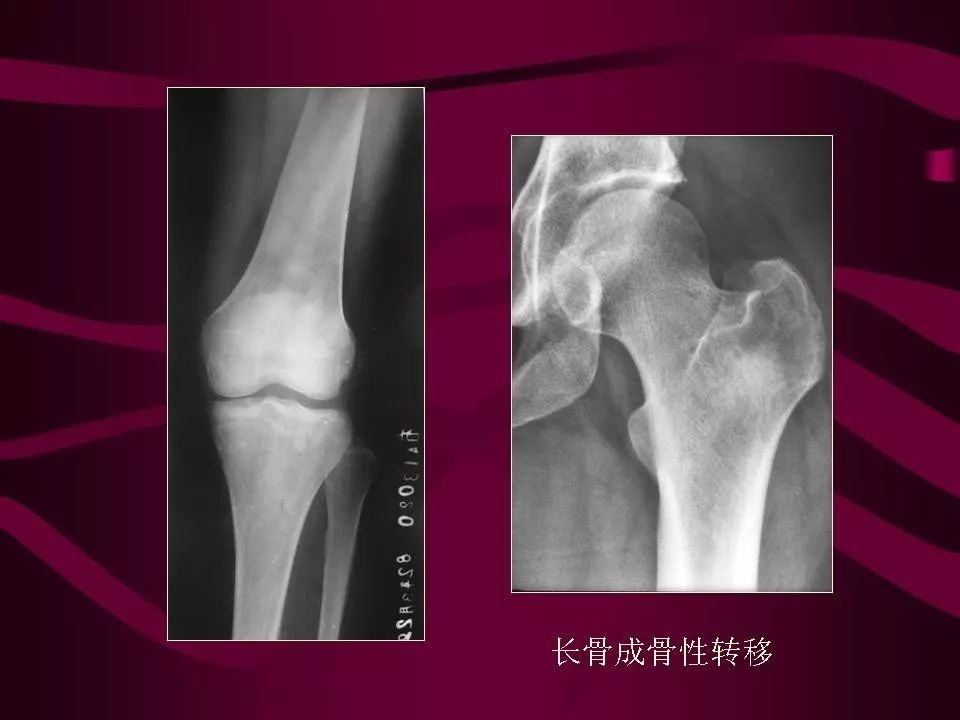 影像PPT - 【PPT】骨转移瘤的影像诊断-34