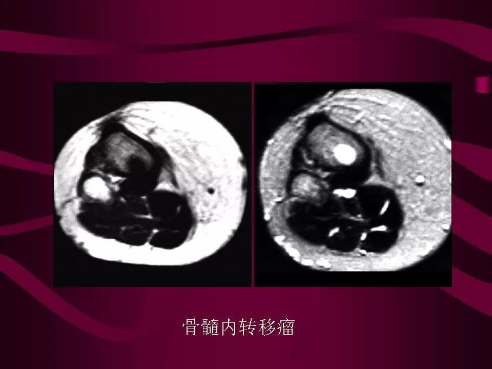 影像PPT - 【PPT】骨转移瘤的影像诊断-30