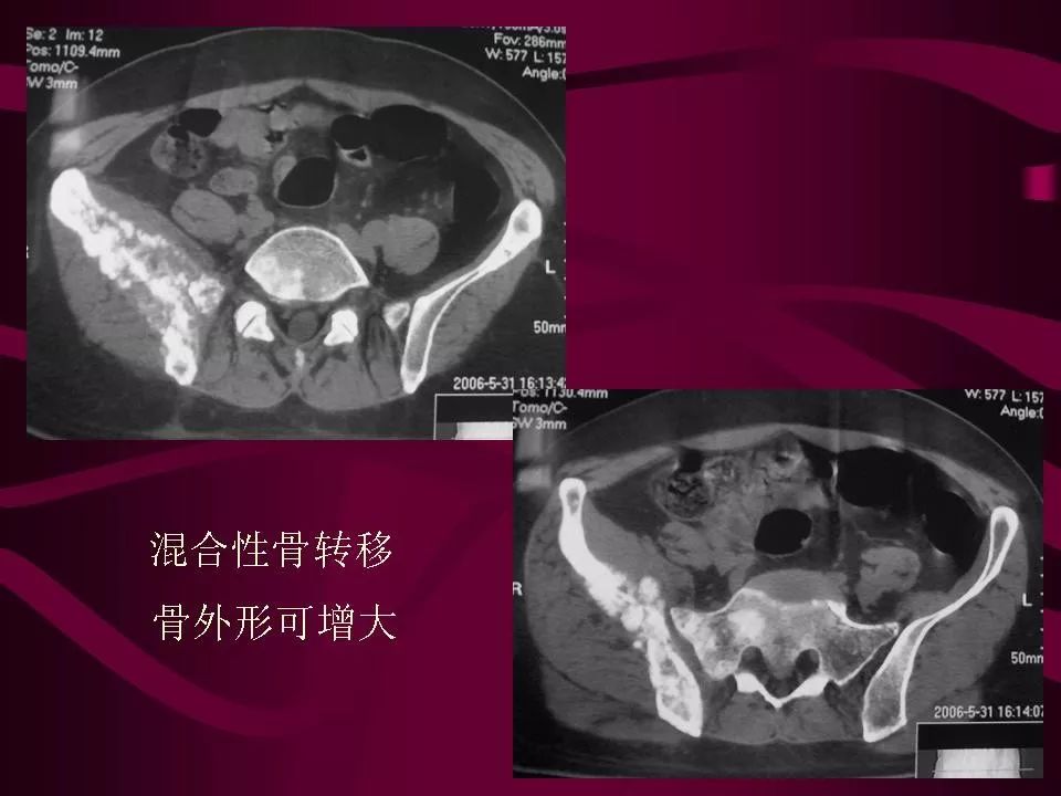 影像PPT - 【PPT】骨转移瘤的影像诊断-35